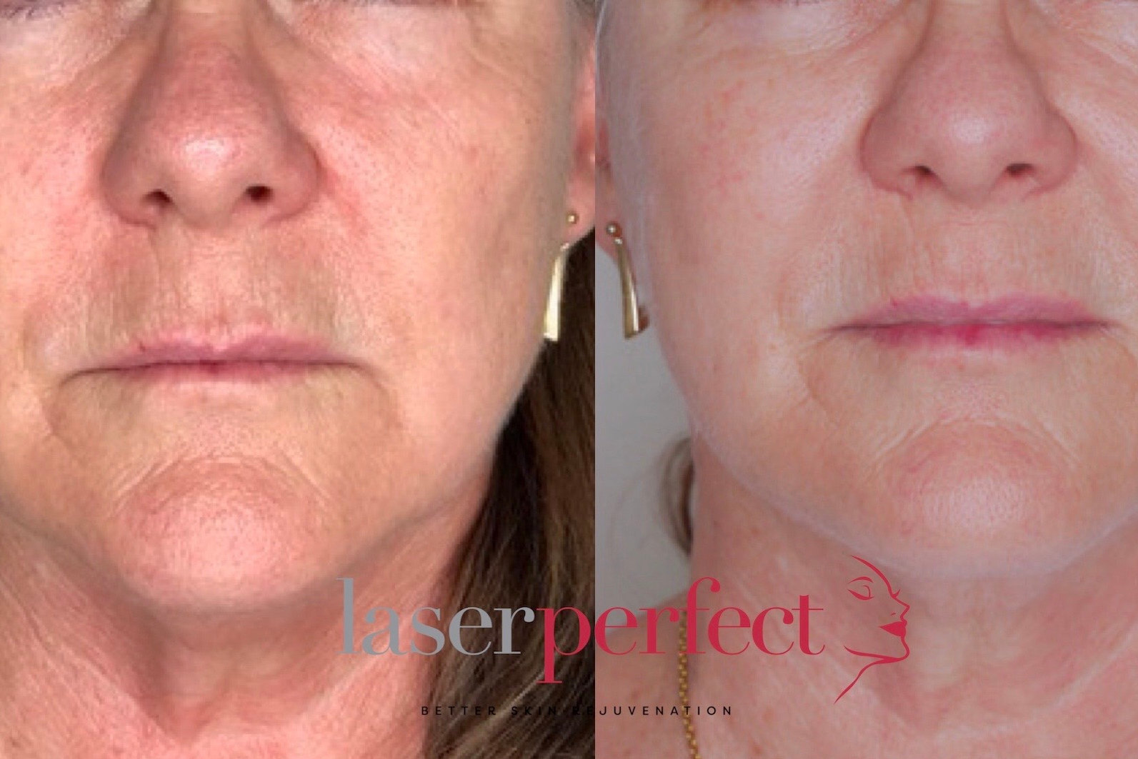 Laser Perfect 3d skin rejuvenation