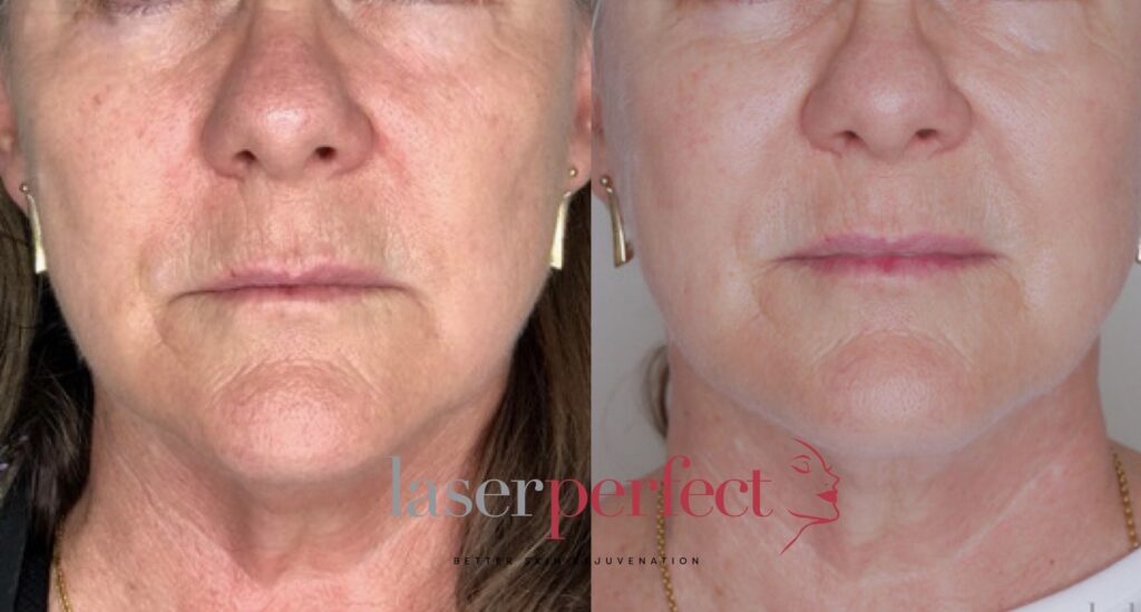 Laser Perfect - 3-D Laser Skin Rejuvenation