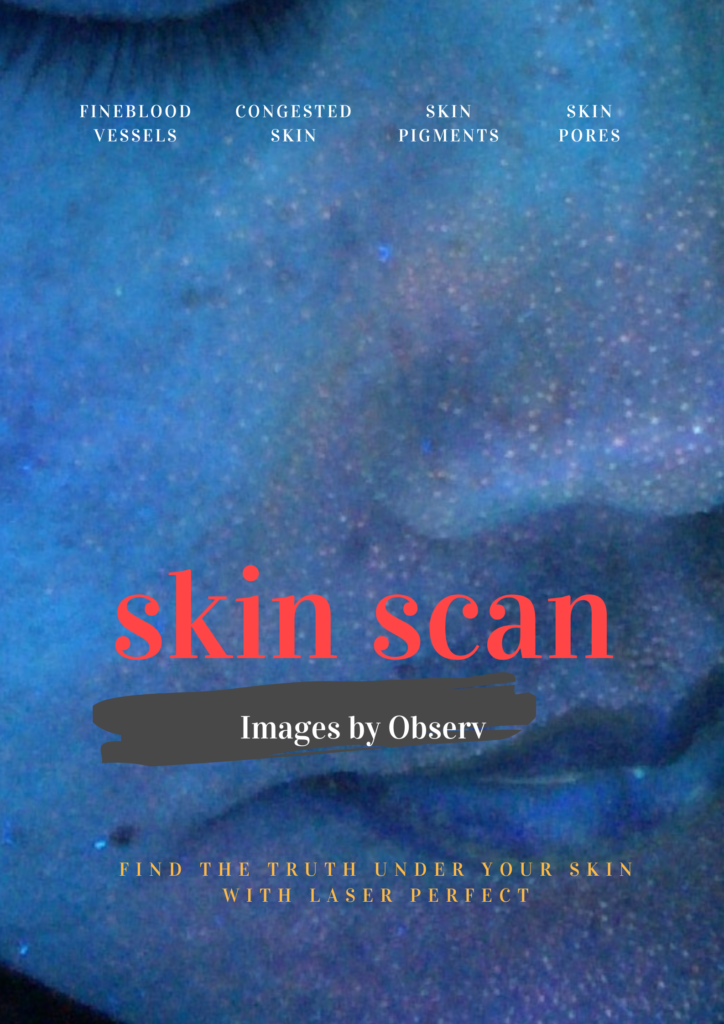 Laser Perfect - Observ Skin Scanning