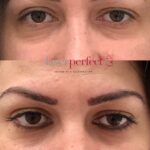 Laser Perfect - Reduction of fine lines around the eyes