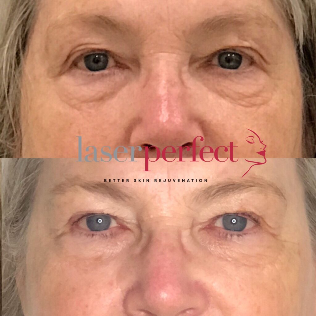 Laser Perfect - Non surgical eyelid lift