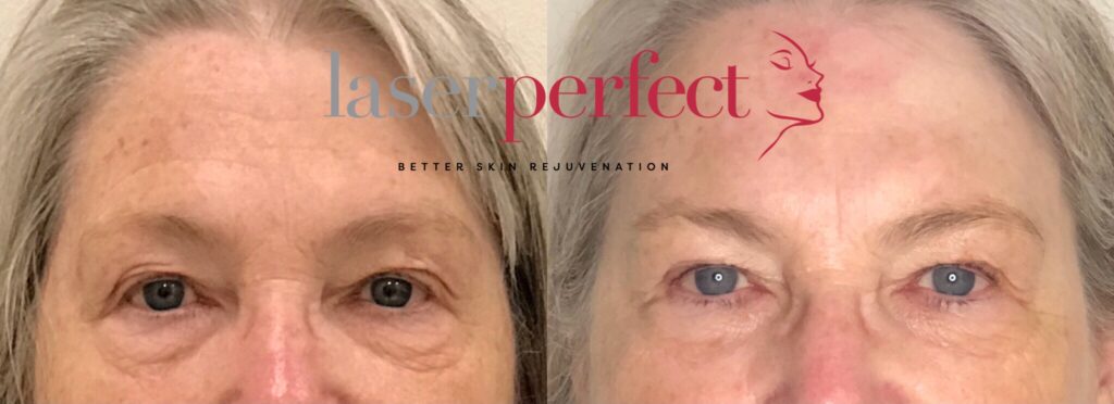 Laser Perfect - Non surgical eyelid lift