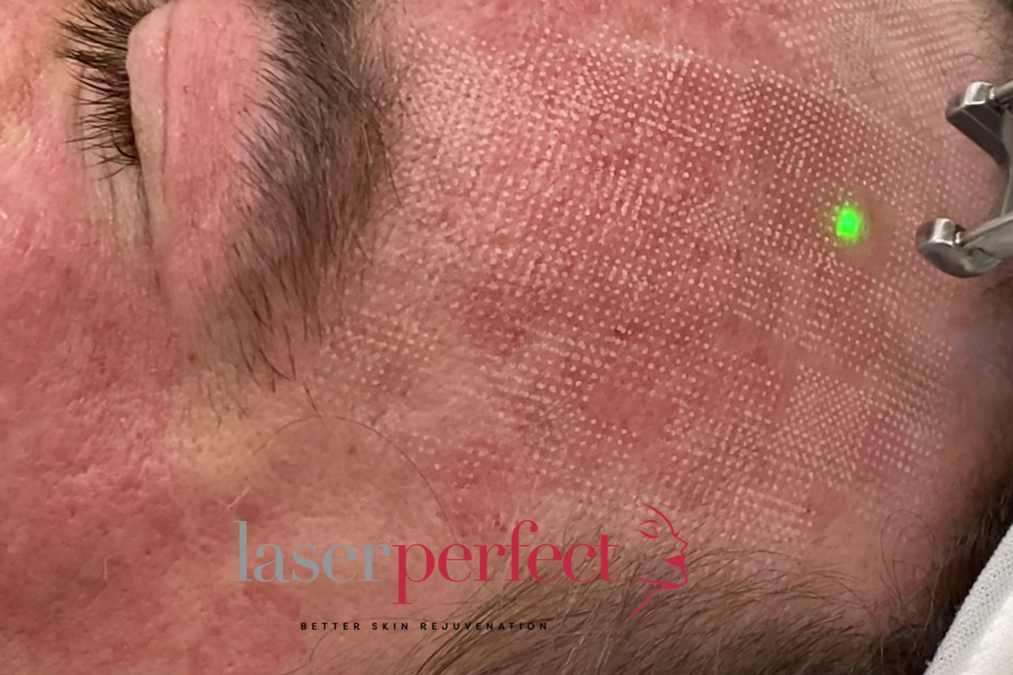 Laser perfect fractional skin peel