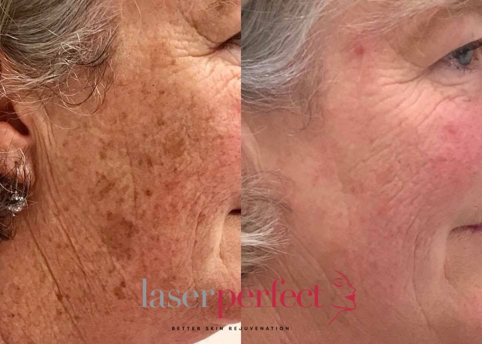 Laser Perfect - Removals of skin pigmentation