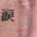 Laser Perfect - Tattoo removals